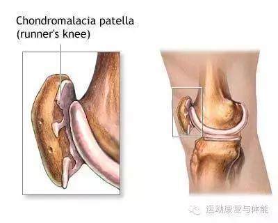 膝关节困疼是怎么回事