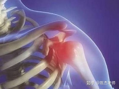 肩关节疼痛怎么治疗