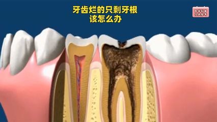 做梦牙烂了怎么回事