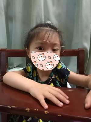 小儿眼睑下垂怎么治疗