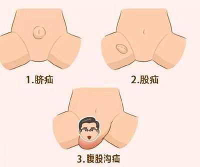 婴儿平躺咳嗽