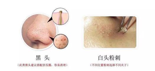 毛孔粗大有黑头粉刺怎么办