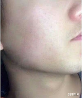 脸上的痘痘忌口鸡么