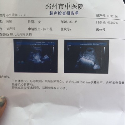 怀孕几天能看到孕囊