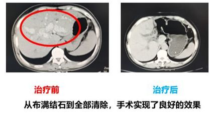 肝上结石怎么治疗最好
