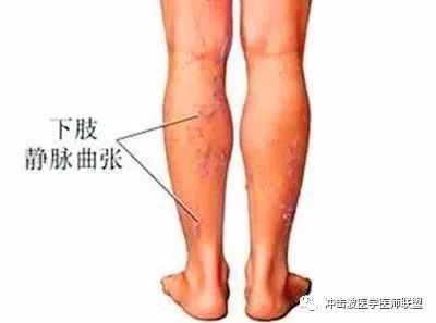 下肢缺血怎么治疗好