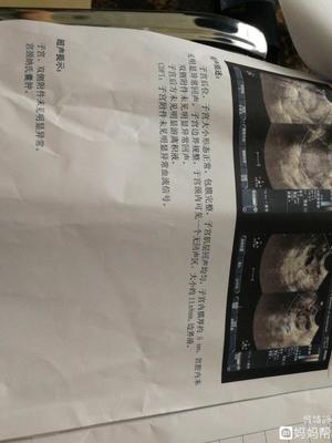 宫颈纳氏囊肿会影响怀孕吗