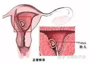 输卵管通而不畅会怀孕吗