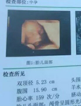 胎儿头围腹围