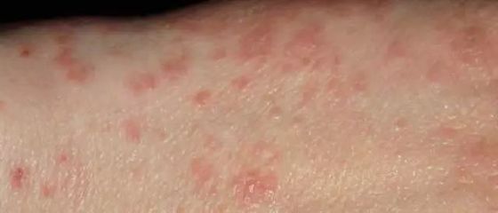 身上长疥疮怎么治疗