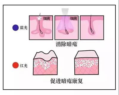 蓝光祛痘原理