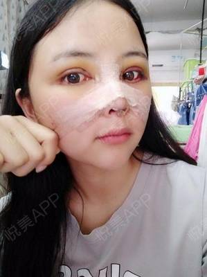 瘦脸针几天有感觉
