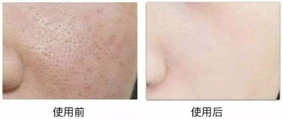 珍珠粉能去背上的痘痘吗