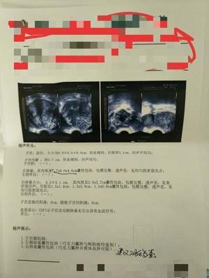 巧克力囊肿手术后多久可以怀孕