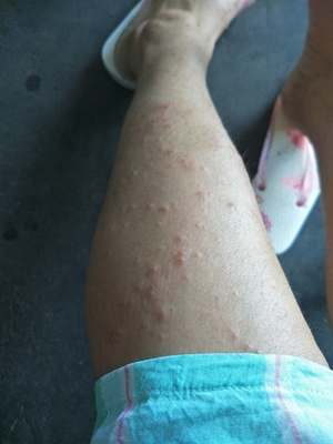 痘痘很痒