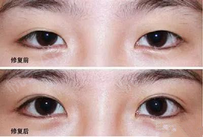 双眼皮不明显咋办