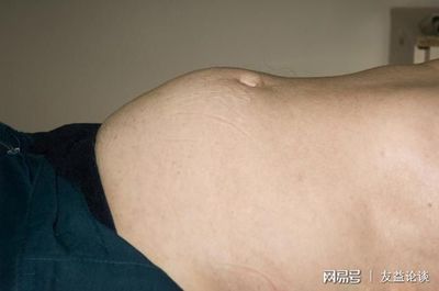 腹胀如鼓是怎么回事