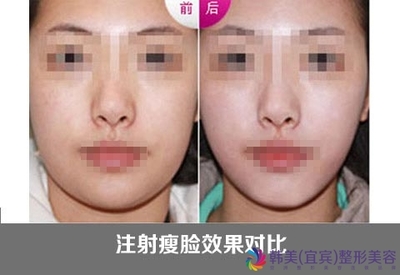 botox注射瘦脸效果