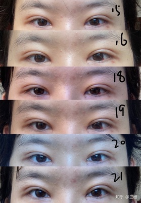 双眼皮疤痕多久才淡化