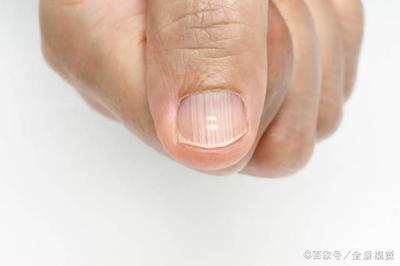 指甲上有黑纹是怎么回事