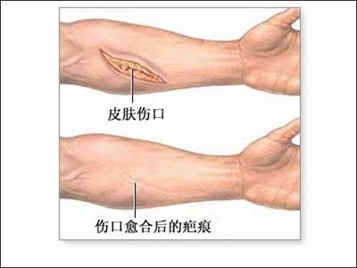中医去疤痕