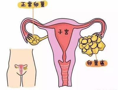 卵巢肿瘤怎么治疗
