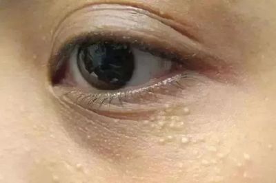 下眼皮长脂肪粒怎么办