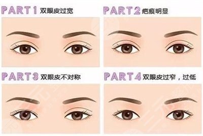 做双眼皮微创