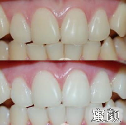 喷沙洗牙