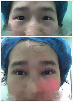 纳米双眼皮后总磨眼睛