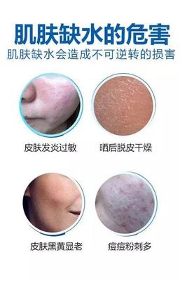 水光针后脱皮正常吗