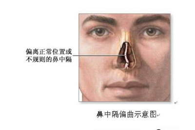 鼻中隔偏曲怎么治疗