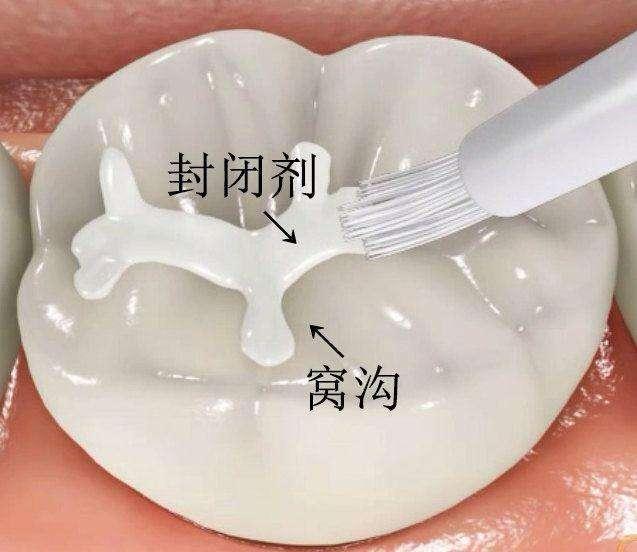 5岁宝宝牙疼