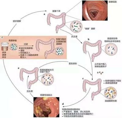 肠道溃疡怎么治疗