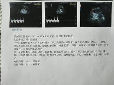 怀孕多少周可以做nt