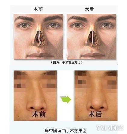 鼻中隔偏曲怎么治疗