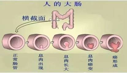 结肠息肉需要多少费用