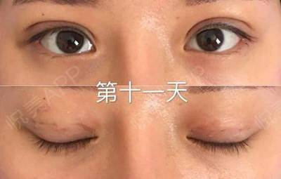 做双眼皮淤青多久能好