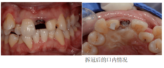 牙齿剩下残根拔掉要多少钱