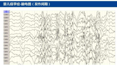 新生儿做脑电图有影响吗