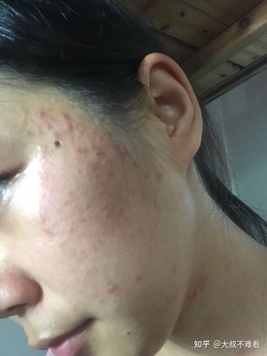右脸长痘痘是怎么回事啊