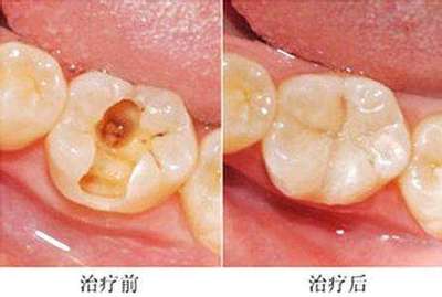 补牙洞痛吗