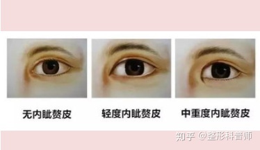 内眦赘皮双眼皮