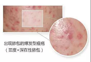挤痘痘出来的白色的东西是什么
