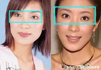 单眼皮怎么整双眼皮
