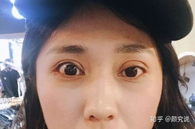 做双眼皮什么季节合适