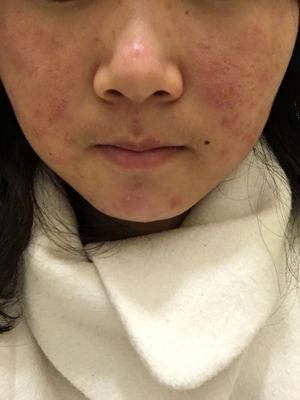 脸部起痤疮如何治
