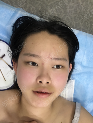 肚子抽脂安全吗