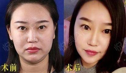 面部吸脂瘦脸效果好吗