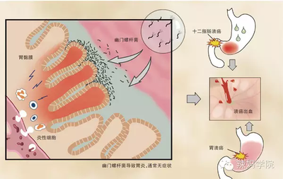 宝宝幽门螺旋杆菌